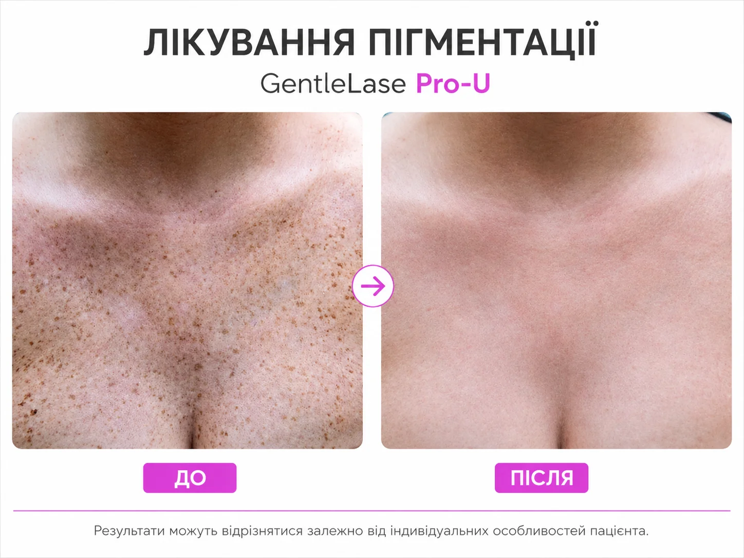 Результат лазерної епіляції пахв до та після